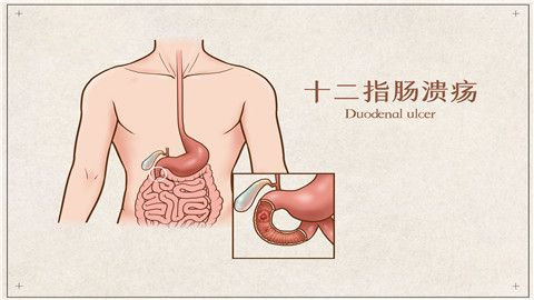 十二直肠溃疡